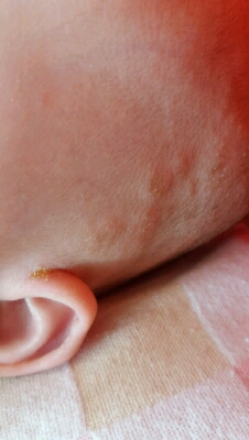宝宝耳朵旁边长癣图片图片