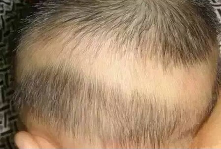 出现枕秃(钙圈)