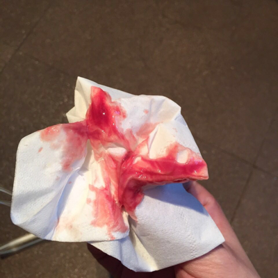 怀孕21周了,前两天突然下身出血,赶去医院做了胎心跟b超宝宝一切正常