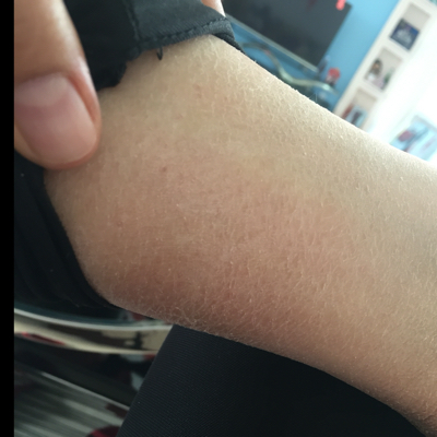 怀孕到现在,脚后跟还有脚腕关节全是黑色素,请问怎样才可以让消失掉