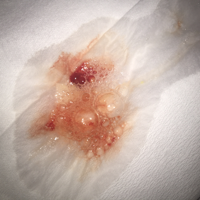 怀孕俩个月了,有时会孕吐,但是最近发现,每次吐都会有血,而且会有几口