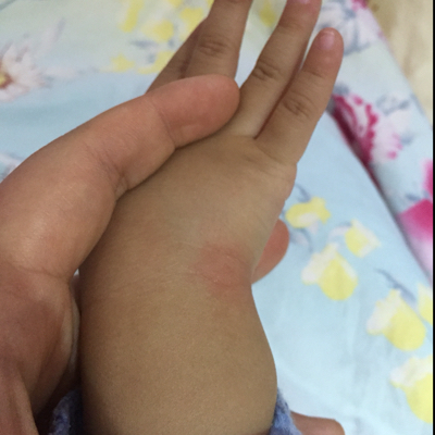 宝宝发烧起疹子图片图片