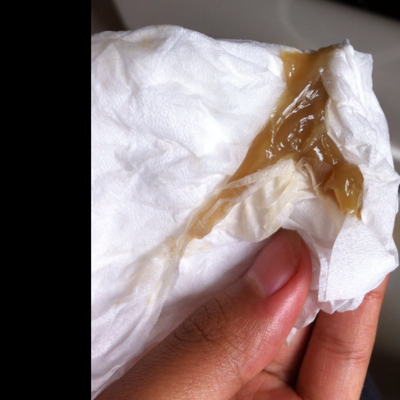 孕25周了 发现最近忽然白带不正常 黄褐色脓块状 好担心不知道是什麼