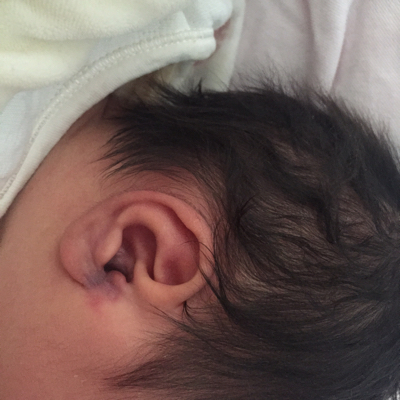 新生儿外耳道炎如何处理 耳屏红肿会消下去吗 要如何处理 宝宝树