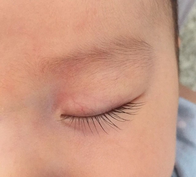 一个月宝宝眼睛上方是否血管瘤?