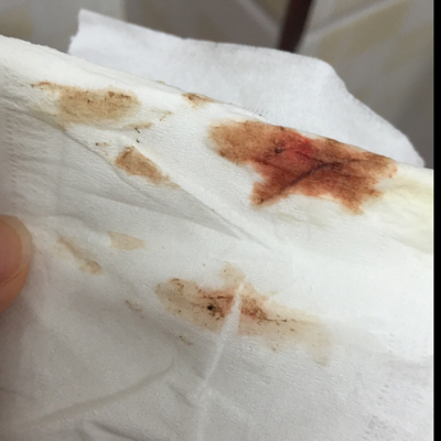 这是血吗,我已经打了两天黄体酮 今天早上突然擦的时候,有这个,很害怕