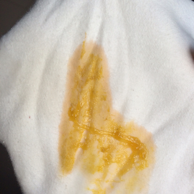 4个月的宝宝大便果冻形状 感觉旁边一圈有点红 怎麼回事?