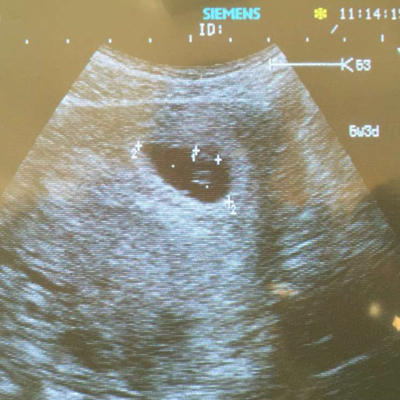 55天男孩孕囊图片图片