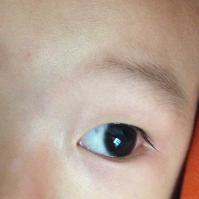 宝宝眼白有黑斑图片图片