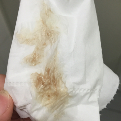 孕6周出现褐色分泌物正常吗?