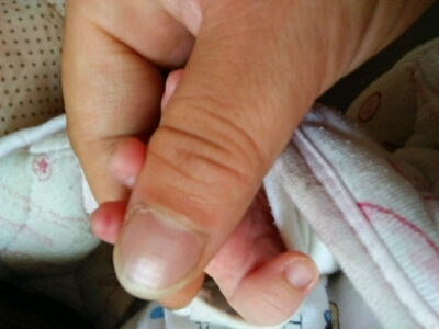 宝宝手指肚红图片图片