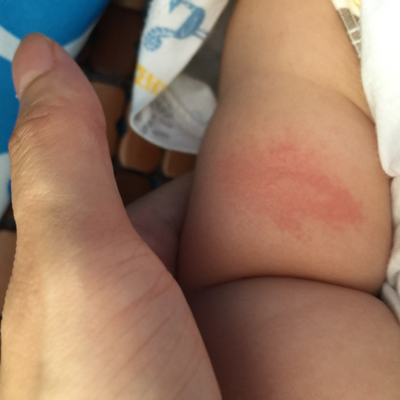 宝宝手臂湿疹图片