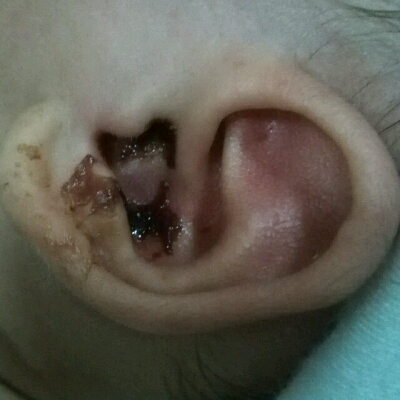 婴儿18天时,左耳留出白色液体,当晚哭得厉害,4天后