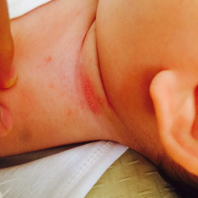 孩子不痛不痒不闹腾,妈妈说是热气跟上火,老公说是我买的痱子粉的问题