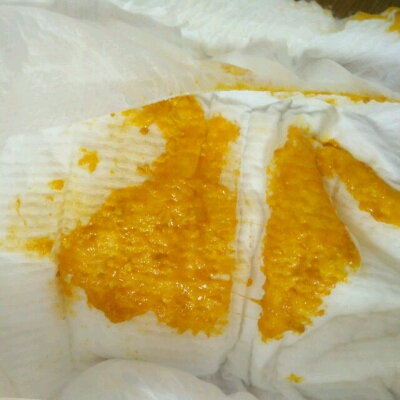 出生第十三天,拉出来屎有点水,怎麼会这样?