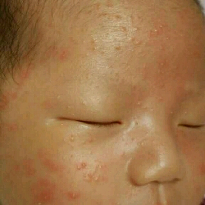 宝宝24天了脸上起的好多红痘痘怎麼回事呢我媳妇身上也有呢