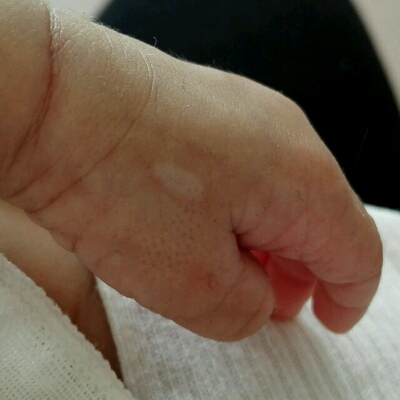 孩子手背上有一块白的地方,从出生就有,感觉像少了一块皮一样,是什么