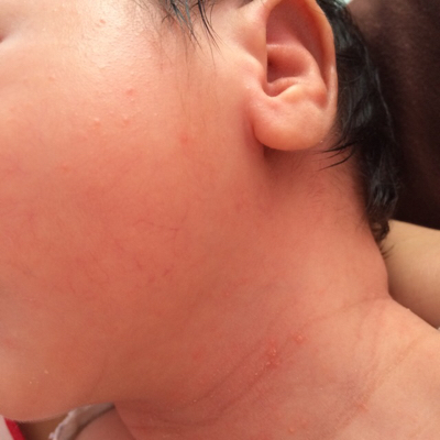 婴儿脖子上有红色斑块图片