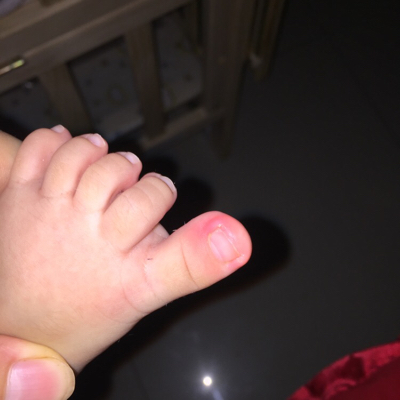 推荐回答                      宝宝的大脚趾应该是有发炎的情况