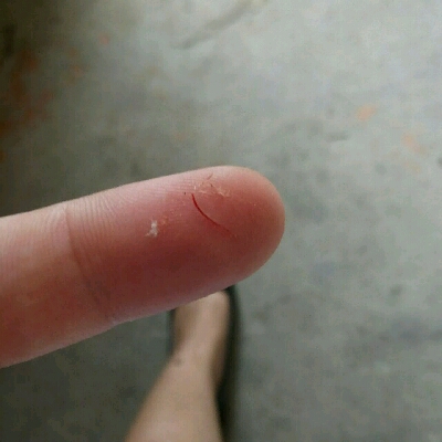 展开阅读全文 嗯,伤口不流血了,也不张开