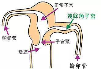 残角子宫分型图片图片