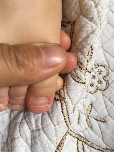 宝宝的甲沟炎终于好了,心疼宝宝!